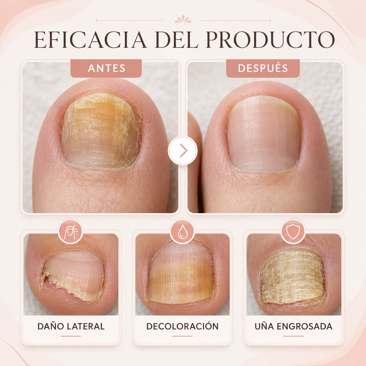 Fungail Nail™ | Parche Para Hongos | Mejora el aspecto de uñas dañadas